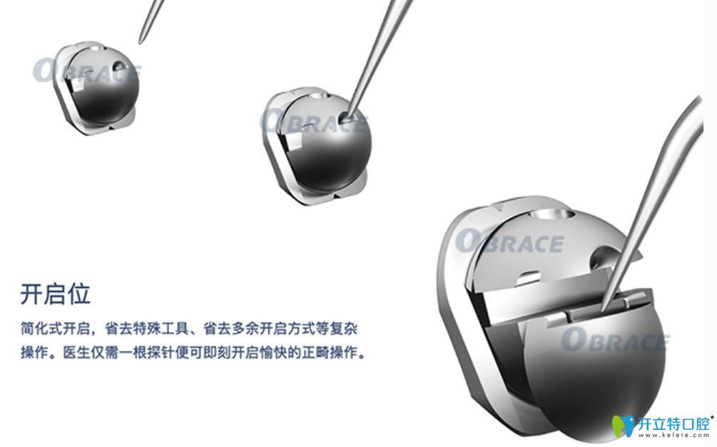 球面自鎖托槽于優(yōu)勢體現(xiàn)