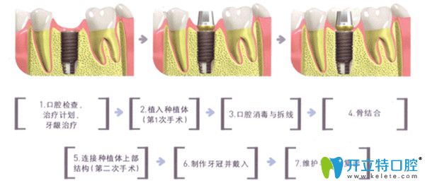 種植牙的安裝步驟