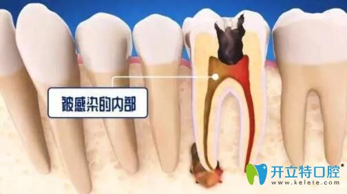 死髓牙不處理會(huì)怎么樣