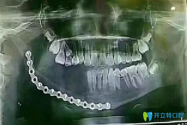 乳牙壞了會影響恒牙嗎?小姑娘因乳牙齲壞花16萬切除下頜骨!