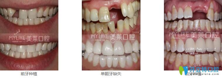 深圳種植牙哪家好？來看美萊口腔真人種植牙案例效果對(duì)比圖