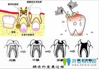 齲齒發(fā)展過程圖解
