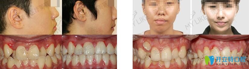 深圳哪里矯正牙齒好？可參考美萊正畸案例