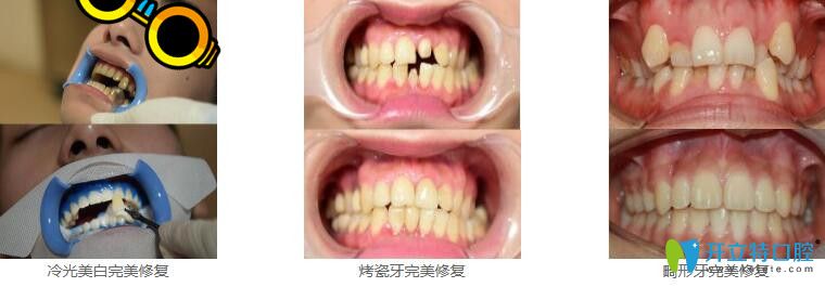 深圳美萊口腔冷光美白+烤瓷牙+瓷貼面修復(fù)畸形牙案例
