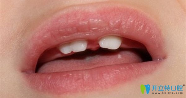 導(dǎo)致融合牙的因素有哪些