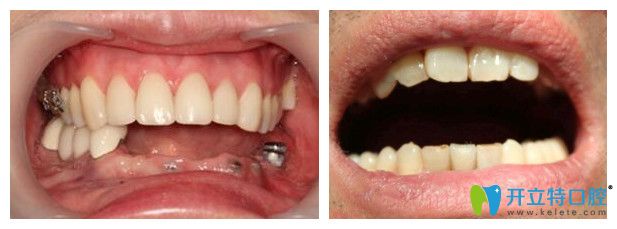 沈陽百嘉麗口腔種植牙案例