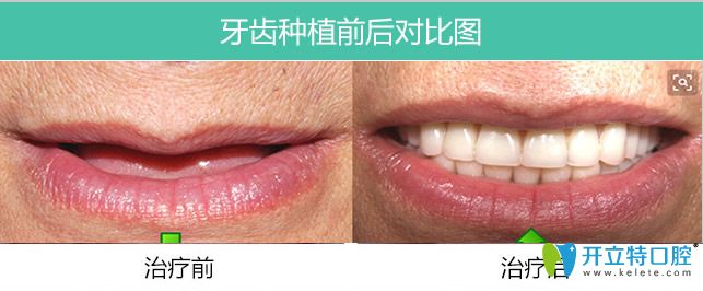 長(zhǎng)春牙博士口腔全口allon4種植牙案例 長(zhǎng)春牙博士口腔全口allon4種植牙案例