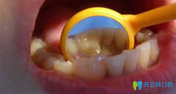 福州艾尚美口腔解析——兒童融合牙換牙后會好嗎？