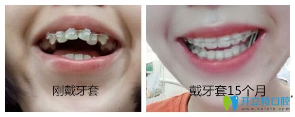 北京圣貝口腔半隱形陶瓷托槽牙齒矯正案例