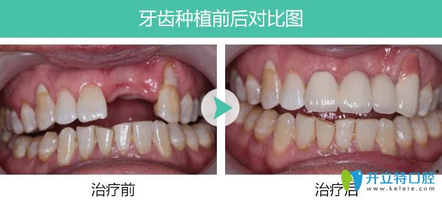 長(zhǎng)春超龍牙博士多顆牙缺失種植案例對(duì)比圖 長(zhǎng)春超龍牙博士多顆牙缺失種植案例對(duì)比圖