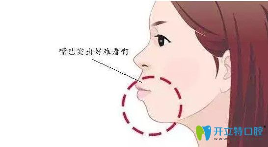 牙齒不暴但是突嘴,解答骨性和牙性突嘴做矯正帶牙套有用嗎?