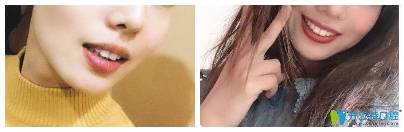 泰州北極星口腔隱形矯正案例前后效果對比圖 泰州北極星口腔隱形矯正案例前后效果對比圖