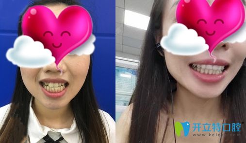 廣州壹加壹口腔的牙齒矯正效果對(duì)比圖