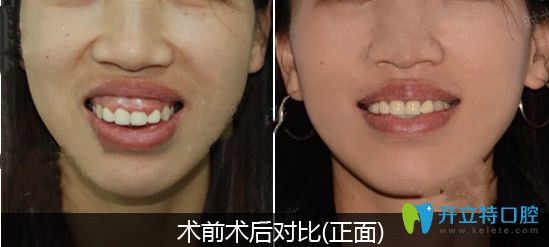 骨性突嘴選擇正頜正畸聯(lián)合治療改善后對(duì)比圖
