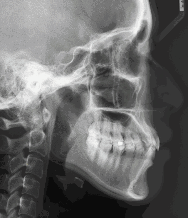 骨性突嘴側(cè)臉形態(tài)動(dòng)圖