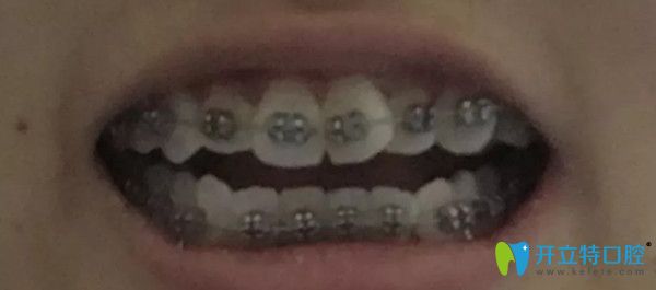 戴上3M自鎖托槽矯正器的照片