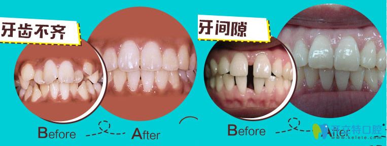無錫佳士潔口腔李復(fù)平牙齒不齊和牙間隙矯正案例圖