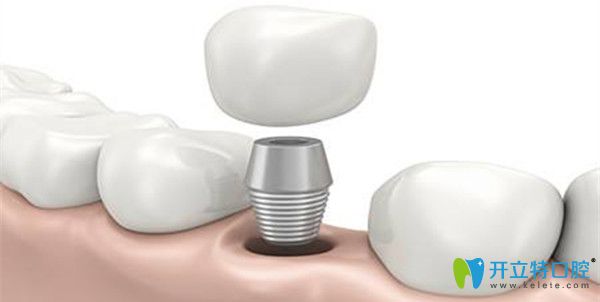 牙齒缺失修復選擇種植牙 牙齒缺失修復選擇種植牙