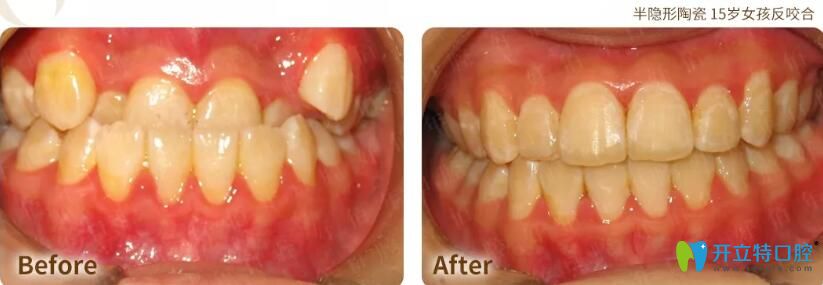 從東莞好佰年口腔案例及評價來判斷好佰年口腔好不好
