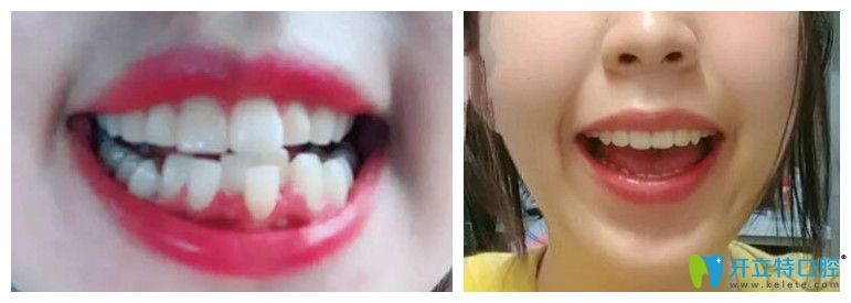 東莞好佰年口腔隱形牙齒矯正案例