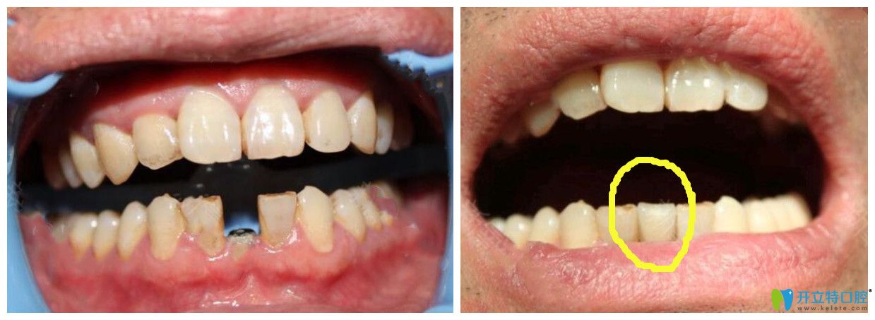 中山好民生口腔收費(fèi)貴嗎?牙齒矯正及種植牙顧客來(lái)告訴你