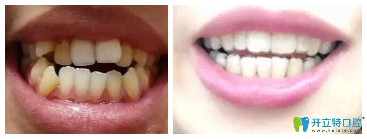 中山好民生口腔隱形牙齒矯正案例