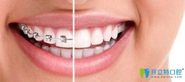列舉深圳牙齒矯正好且正規(guī)的口腔機構,附價格表及顧客評價