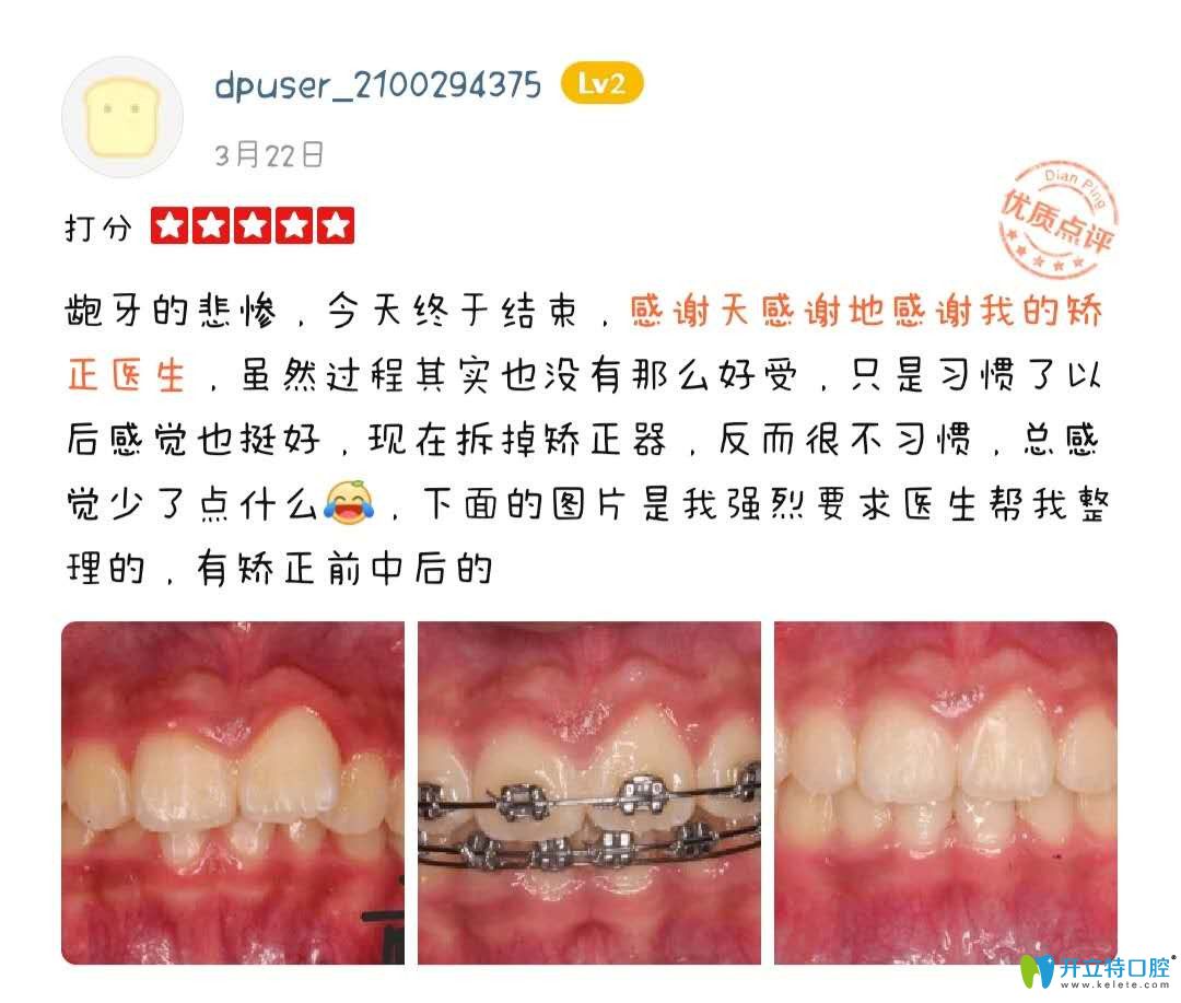 在<!--<i data=20240703-sp></i>-->做正畸后的點(diǎn)評