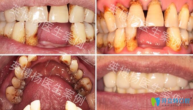 <!--<i data=20240703-sp></i>-->英博口腔種植牙好不好？來看夏偉院長(zhǎng)種植牙過程案例
