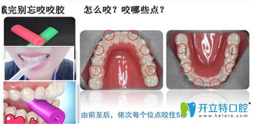 每次戴牙套的時候必須要用正畸咬膠