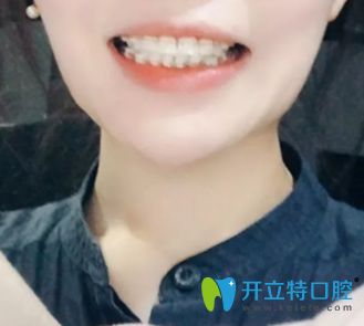 <!--<i data=20240703-sp></i>-->口腔陶瓷托槽隱形矯正術(shù)后1年半效果圖