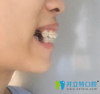 <!--<i data=20240703-sp></i>-->牙科牙齒正畸過程圖