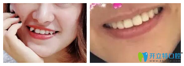 長春超龍牙博士口腔隱形牙齒矯正案例 長春超龍牙博士口腔隱形牙齒矯正案例