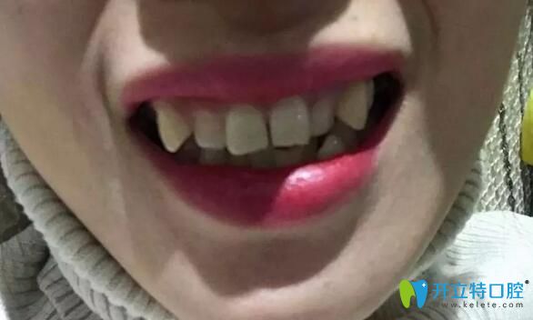 自己在北京麗都口腔做金屬自鎖托槽牙齒矯正1年的正畸日志