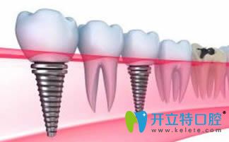 周宇醫(yī)生擅長各類種植牙技術(shù) 周宇醫(yī)生擅長各類種植牙技術(shù)