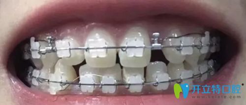 在北京康貝佳口腔整牙效果:陶瓷托槽矯正牙齒稀疏7個月變化
