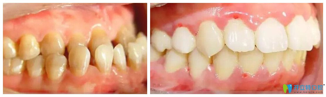 正畸案例來看看歡樂仁愛口腔矯正好不