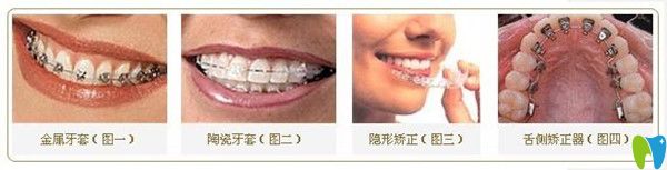 牙齒矯正的不同分類
