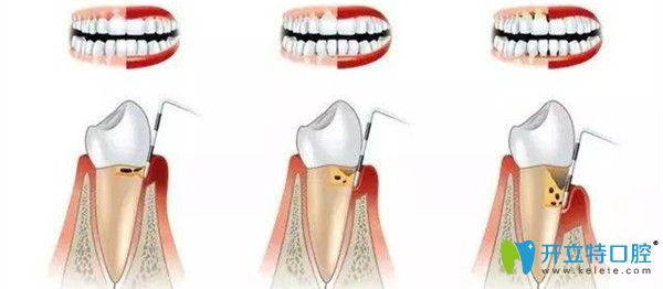 洗牙與牙周治療的區(qū)別