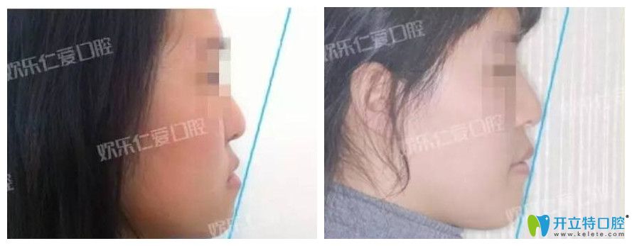 歡樂仁愛口腔骨性反合的掩飾性治療案例