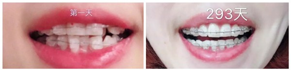 趁上海美維口腔正畸優(yōu)惠,做的陶瓷托槽矯正價格不貴效果好