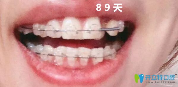 正畸第三個月變化圖 正畸第三個月變化圖