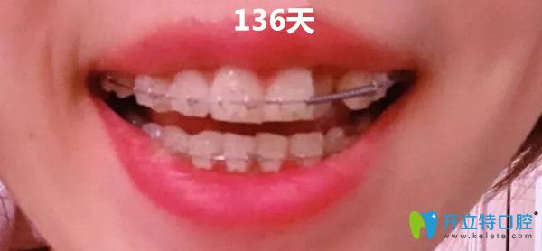 在<!--<i data=20240703-sp></i>-->美維口腔做矯正第136天 在<!--<i data=20240703-sp></i>-->美維口腔做矯正第136天