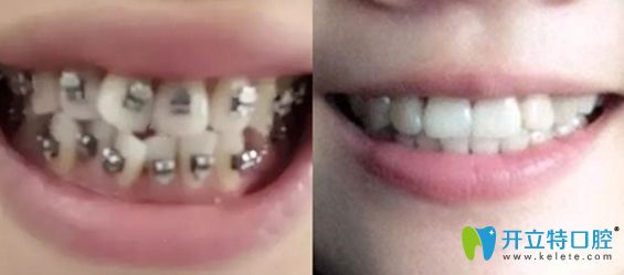 深圳潤(rùn)澤瑞尼絲口腔牙齒矯正效果對(duì)比圖 深圳潤(rùn)澤瑞尼絲口腔牙齒矯正效果對(duì)比圖