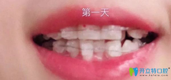 剛帶上牙套的第1天 剛帶上牙套的第1天