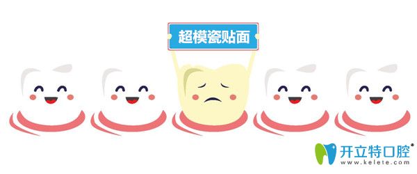 超模瓷貼片好不好？解析超模瓷貼面和全瓷貼面的區(qū)別