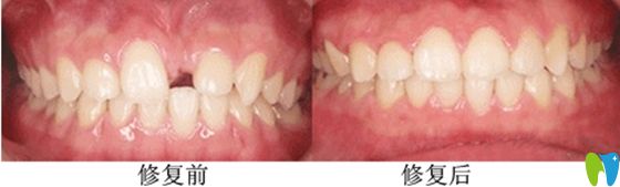 鄭州德正口腔前牙美學(xué)種植前后效果對比圖