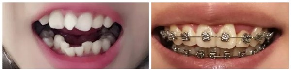 長沙整牙哪里比較好?我在優(yōu)享口腔做金屬托槽矯正效果不錯