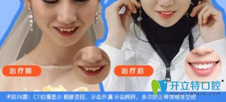 仁愛口腔牙齒外漏、擁擠矯正案例