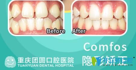 團(tuán)圓口腔牙齒稀疏采用時代天使隱形矯正前后效果對比